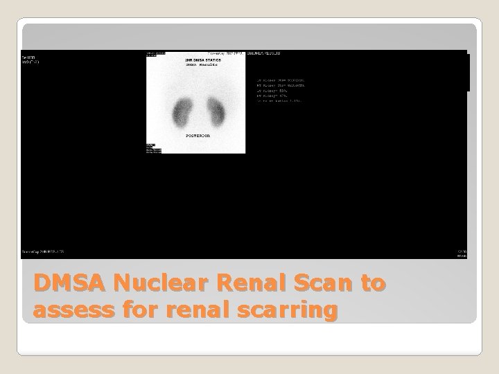 DMSA Nuclear Renal Scan to assess for renal scarring 