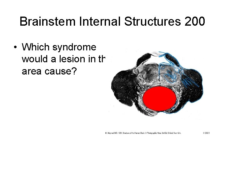 Brainstem Internal Structures 200 • Which syndrome would a lesion in this area cause? Brainstem Internal Structures 200 • Which syndrome would a lesion in this area cause?