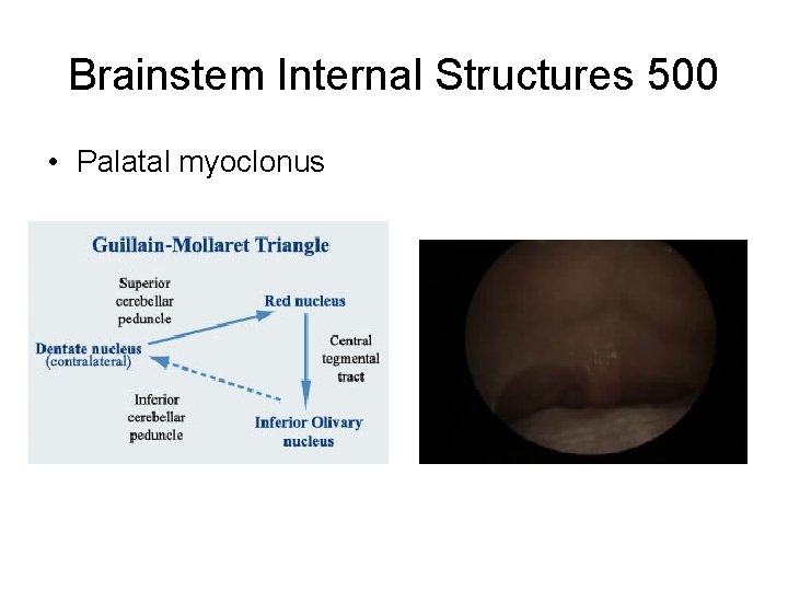 Brainstem Internal Structures 500 • Palatal myoclonus Brainstem Internal Structures 500 • Palatal myoclonus
