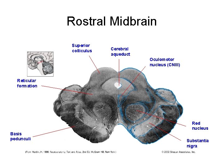 Rostral Midbrain Superior colliculus Cerebral aqueduct Oculomotor nucleus (CNIII) Reticular formation Red nucleus Basis Rostral Midbrain Superior colliculus Cerebral aqueduct Oculomotor nucleus (CNIII) Reticular formation Red nucleus Basis
