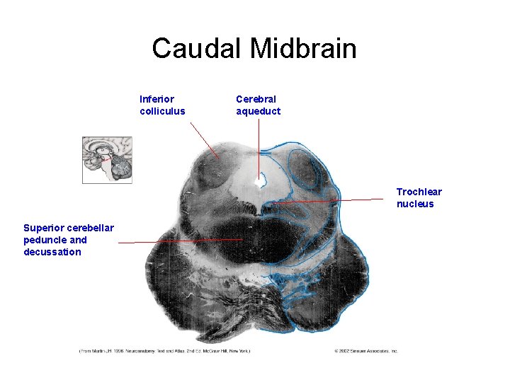 Caudal Midbrain Inferior colliculus Cerebral aqueduct Trochlear nucleus Superior cerebellar peduncle and decussation Caudal Midbrain Inferior colliculus Cerebral aqueduct Trochlear nucleus Superior cerebellar peduncle and decussation