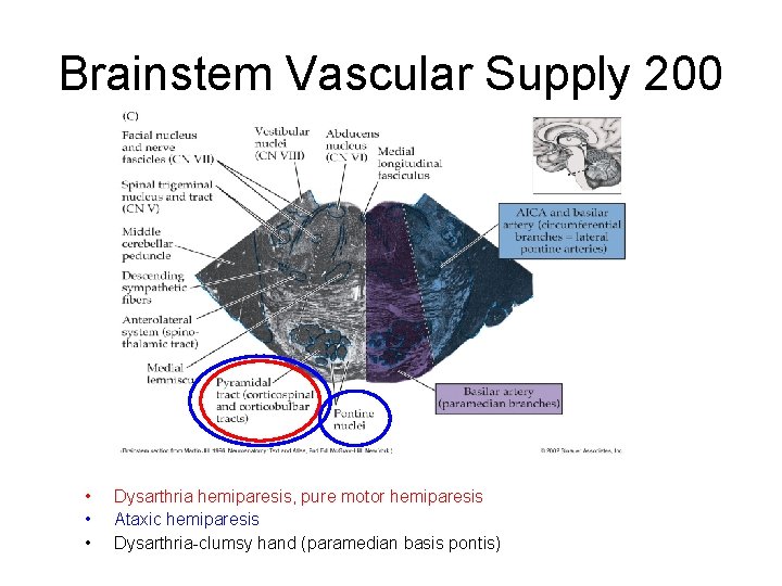 Brainstem Vascular Supply 200 • • • Dysarthria hemiparesis, pure motor hemiparesis Ataxic hemiparesis Brainstem Vascular Supply 200 • • • Dysarthria hemiparesis, pure motor hemiparesis Ataxic hemiparesis