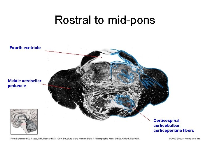 Rostral to mid-pons Fourth ventricle Middle cerebellar peduncle Corticospinal, corticobulbar, corticopontine fibers Rostral to mid-pons Fourth ventricle Middle cerebellar peduncle Corticospinal, corticobulbar, corticopontine fibers