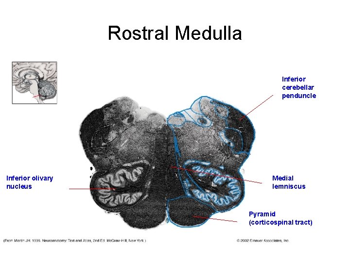 Rostral Medulla Inferior cerebellar penduncle Inferior olivary nucleus Medial lemniscus Pyramid (corticospinal tract) Rostral Medulla Inferior cerebellar penduncle Inferior olivary nucleus Medial lemniscus Pyramid (corticospinal tract)