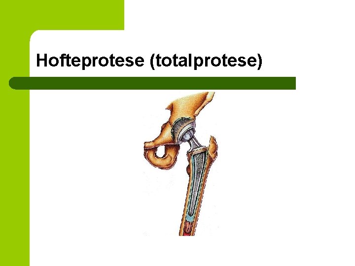 Hofteprotese (totalprotese) 