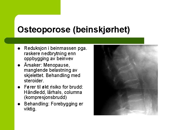 Osteoporose (beinskjørhet) l l Reduksjon i beinmassen pga. raskere nedbrytning enn oppbygging av beinvev