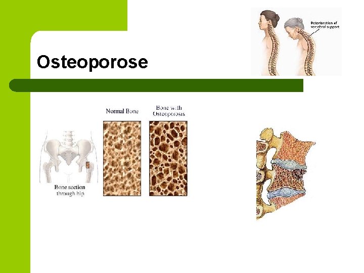 Osteoporose 