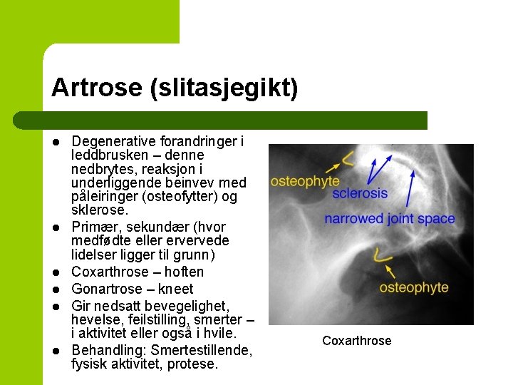 Artrose (slitasjegikt) l l l Degenerative forandringer i leddbrusken – denne nedbrytes, reaksjon i