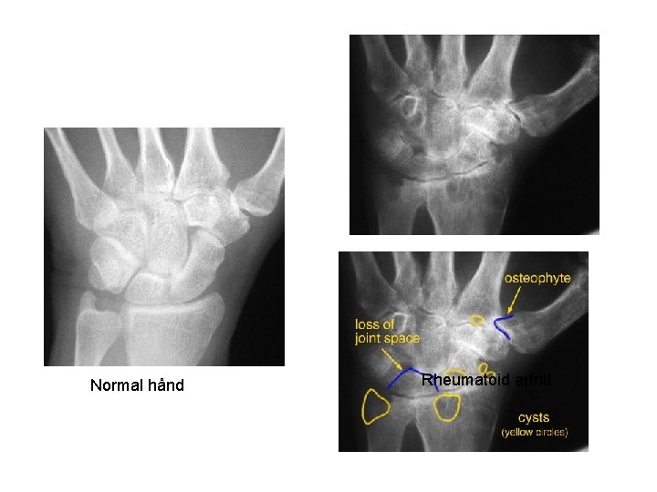 Normal hånd Rheumatoid artritt 