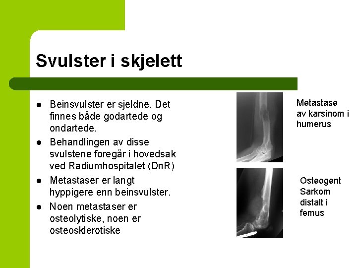 Svulster i skjelett l l Beinsvulster er sjeldne. Det finnes både godartede og ondartede.