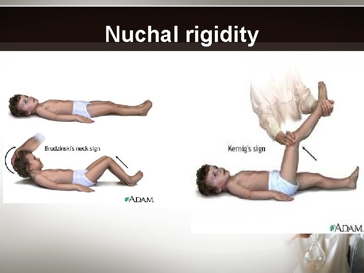 Nuchal rigidity 