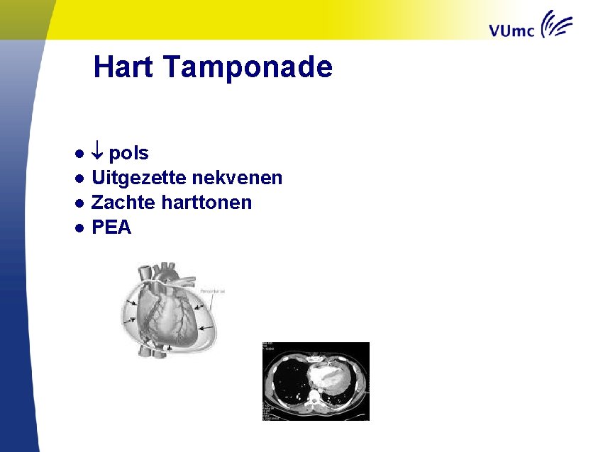 Hart Tamponade ● ● pols Uitgezette nekvenen Zachte harttonen PEA 
