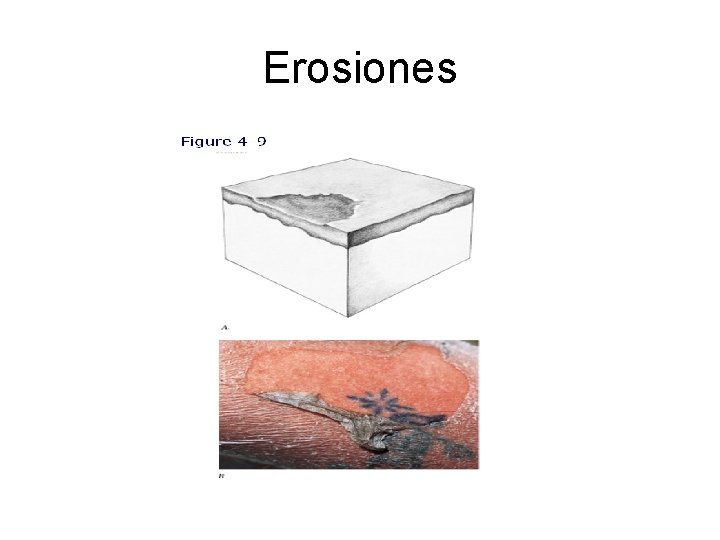 Erosiones 