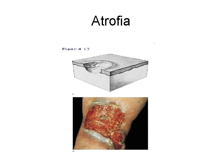 Atrofia 