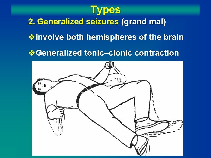 Types 2. Generalized seizures (grand mal) vinvolve both hemispheres of the brain v. Generalized