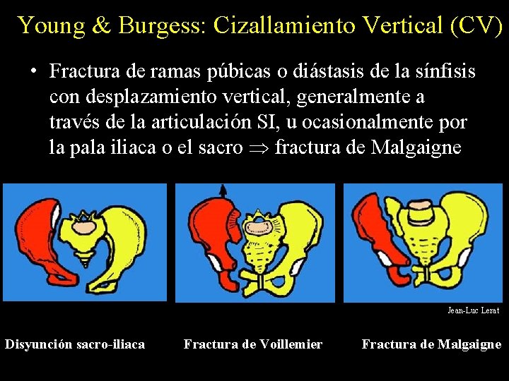 Young & Burgess: Cizallamiento Vertical (CV) • Fractura de ramas púbicas o diástasis de