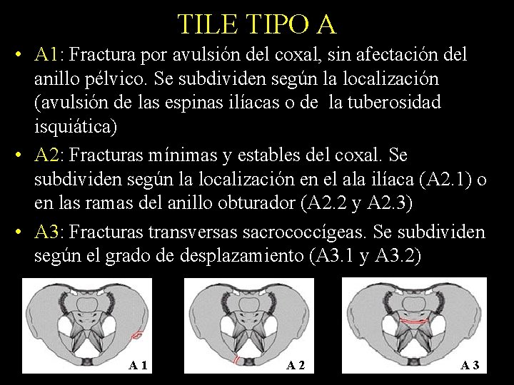 TILE TIPO A • A 1: Fractura por avulsión del coxal, sin afectación del