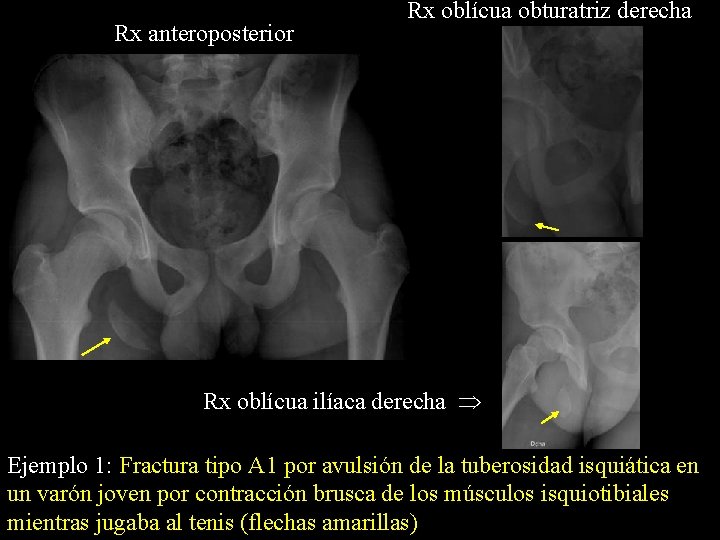 Rx anteroposterior Rx oblícua obturatriz derecha Rx oblícua ilíaca derecha Ejemplo 1: Fractura tipo