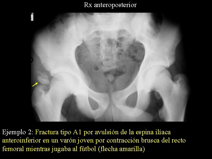 Rx anteroposterior Ejemplo 2: Fractura tipo A 1 por avulsión de la espina ilíaca