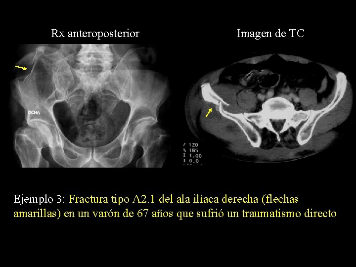 Rx anteroposterior Imagen de TC Ejemplo 3: Fractura tipo A 2. 1 del ala
