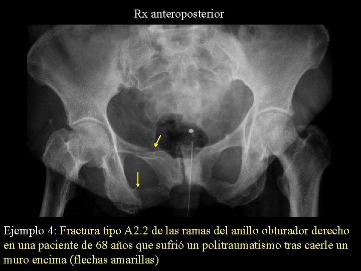 Rx anteroposterior Ejemplo 4: Fractura tipo A 2. 2 de las ramas del anillo