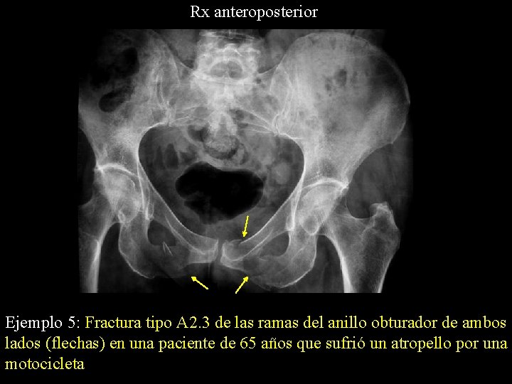 Rx anteroposterior Ejemplo 5: Fractura tipo A 2. 3 de las ramas del anillo