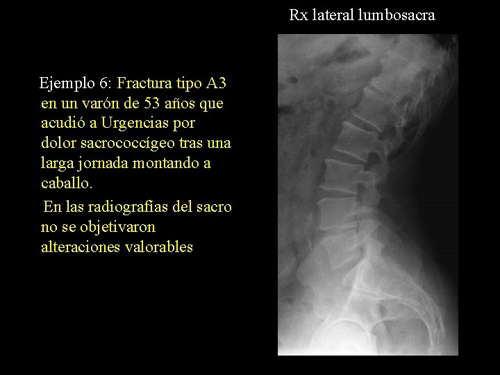 Rx lateral lumbosacra Ejemplo 6: Fractura tipo A 3 en un varón de 53