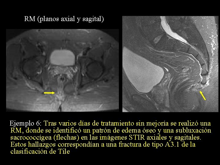 RM (planos axial y sagital) Ejemplo 6: Tras varios días de tratamiento sin mejoría