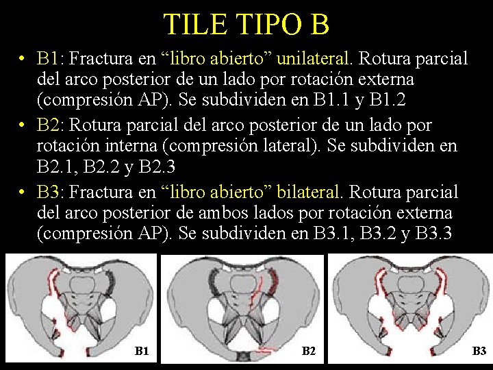 TILE TIPO B • B 1: Fractura en “libro abierto” unilateral. Rotura parcial del
