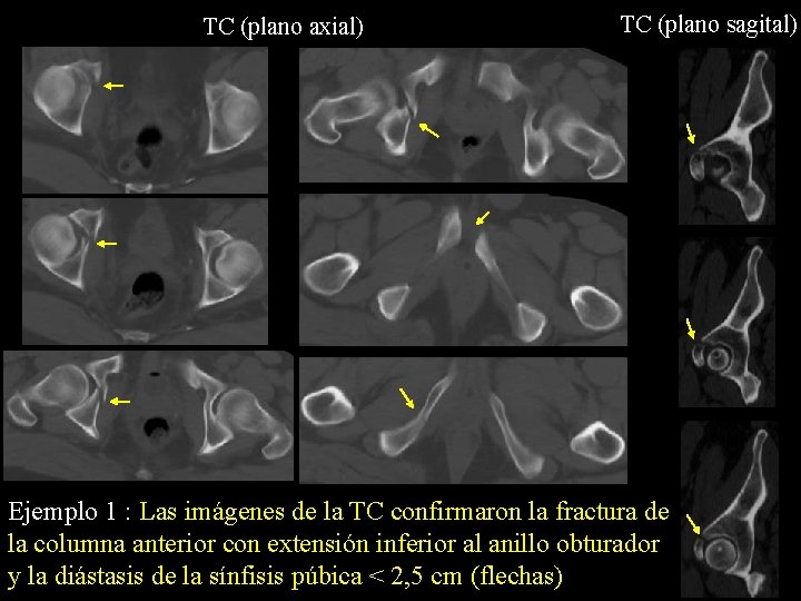 TC (plano axial) TC (plano sagital) Ejemplo 1 : Las imágenes de la TC