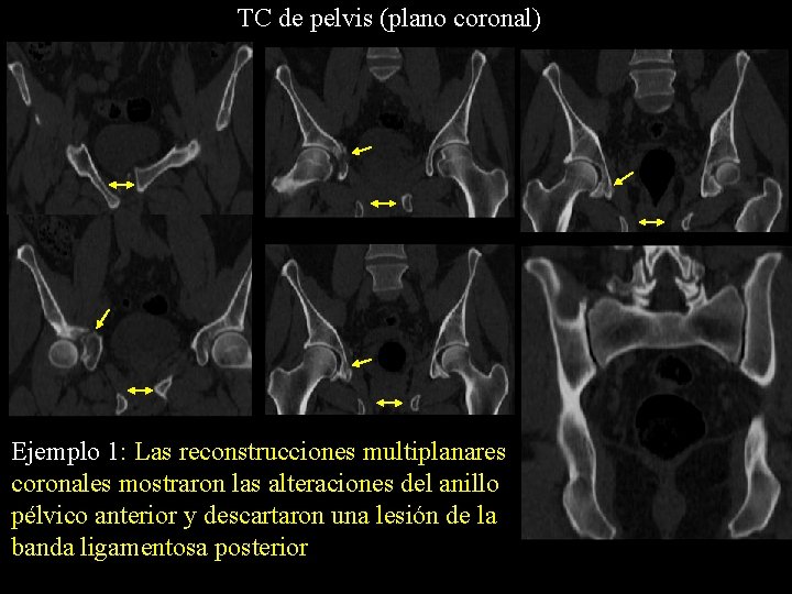TC de pelvis (plano coronal) Ejemplo 1: Las reconstrucciones multiplanares coronales mostraron las alteraciones