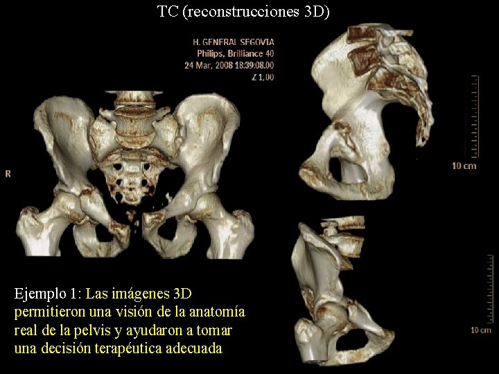 TC (reconstrucciones 3 D) Ejemplo 1: Las imágenes 3 D permitieron una visión de