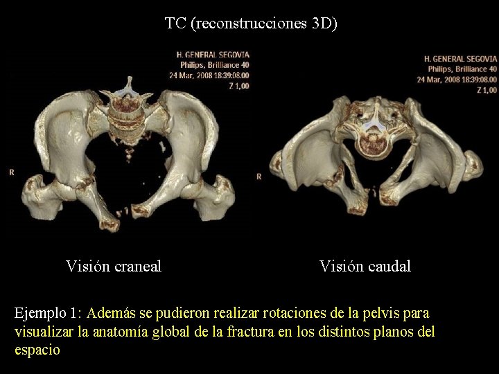 TC (reconstrucciones 3 D) Visión craneal Visión caudal Ejemplo 1: Además se pudieron realizar