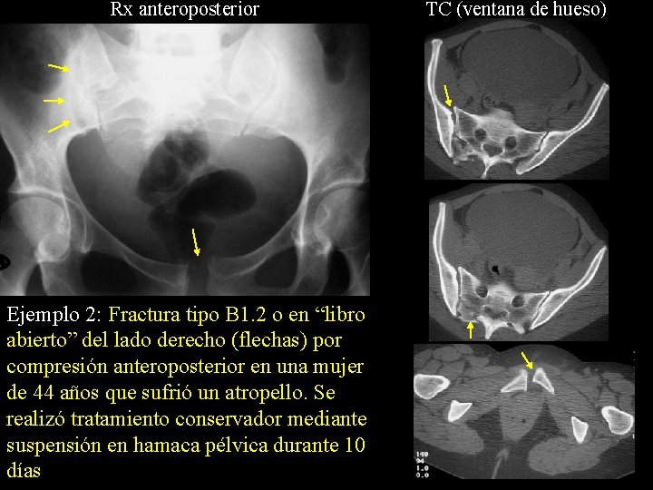 Rx anteroposterior Ejemplo 2: Fractura tipo B 1. 2 o en “libro abierto” del