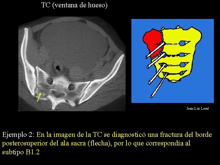 TC (ventana de hueso) Jean-Luc Lerat Ejemplo 2: En la imagen de la TC