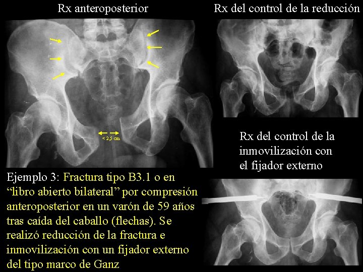 Rx anteroposterior < 2, 5 cm Ejemplo 3: Fractura tipo B 3. 1 o