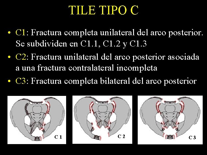 TILE TIPO C • C 1: Fractura completa unilateral del arco posterior. Se subdividen