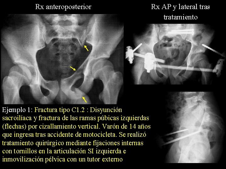Rx anteroposterior Ejemplo 1: Fractura tipo C 1. 2 : Disyunción sacroilíaca y fractura