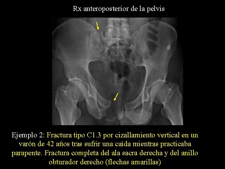 Rx anteroposterior de la pelvis Ejemplo 2: Fractura tipo C 1. 3 por cizallamiento