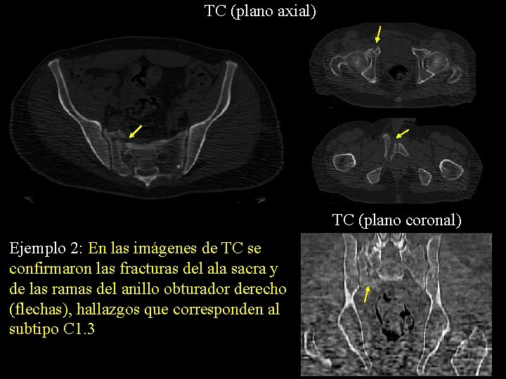 TC (plano axial) TC (plano coronal) Ejemplo 2: En las imágenes de TC se
