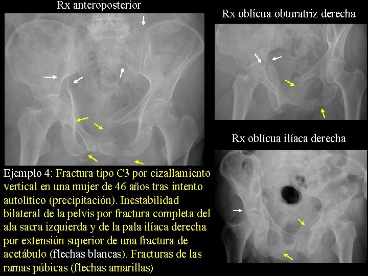 Rx anteroposterior Rx oblícua obturatriz derecha Rx oblícua ilíaca derecha Ejemplo 4: Fractura tipo