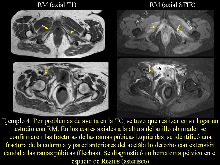 RM (axial T 1) RM (axial STIR) * Ejemplo 4: Por problemas de avería