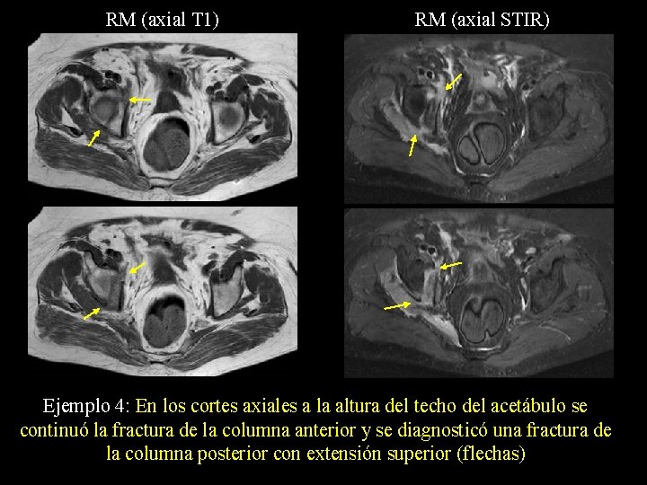 RM (axial T 1) RM (axial STIR) Ejemplo 4: En los cortes axiales a