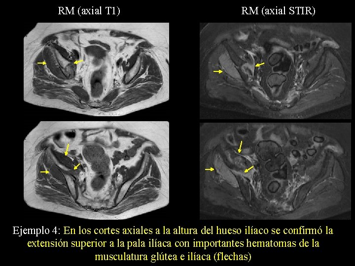 RM (axial T 1) RM (axial STIR) Ejemplo 4: En los cortes axiales a