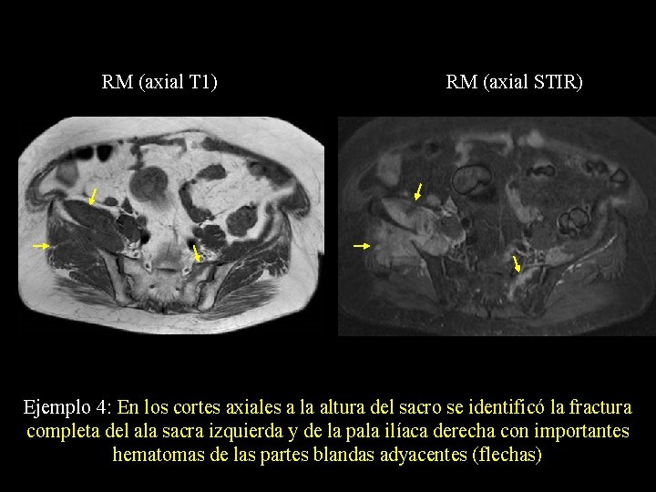 RM (axial T 1) RM (axial STIR) Ejemplo 4: En los cortes axiales a