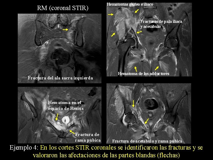 RM (coronal STIR) Hematomas glúteo e ilíaco Fracturas de pala ilíaca y acetábulo Fractura