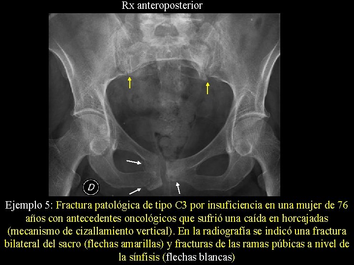 Rx anteroposterior Ejemplo 5: Fractura patológica de tipo C 3 por insuficiencia en una