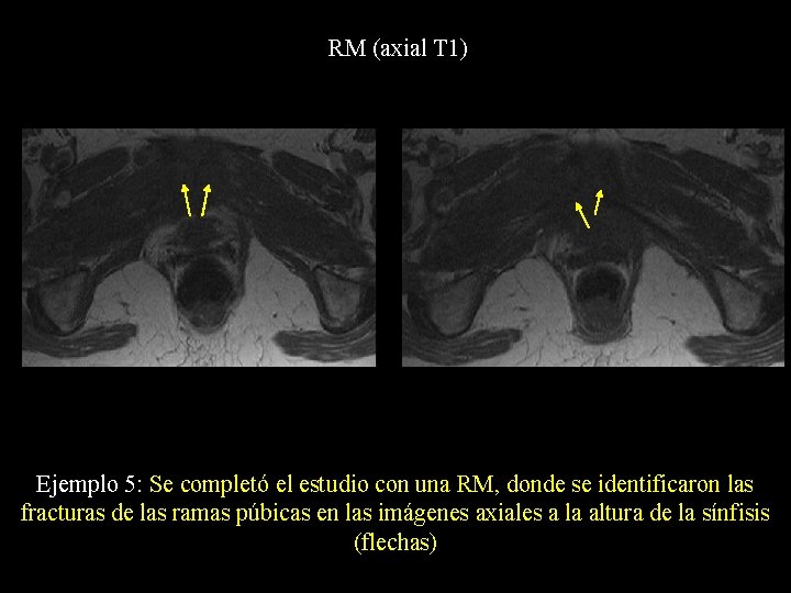 RM (axial T 1) Ejemplo 5: Se completó el estudio con una RM, donde