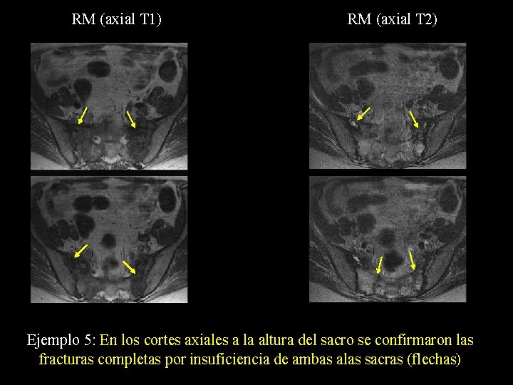 RM (axial T 1) RM (axial T 2) Ejemplo 5: En los cortes axiales