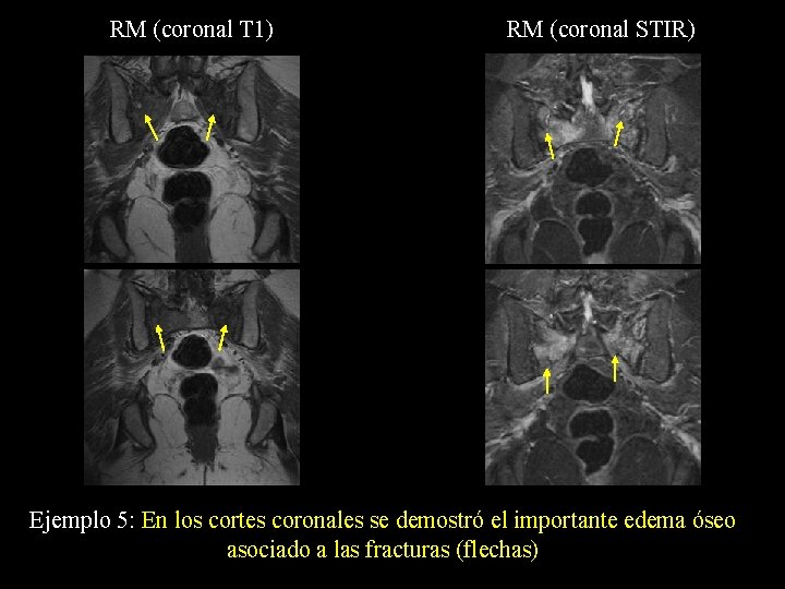 RM (coronal T 1) RM (coronal STIR) Ejemplo 5: En los cortes coronales se